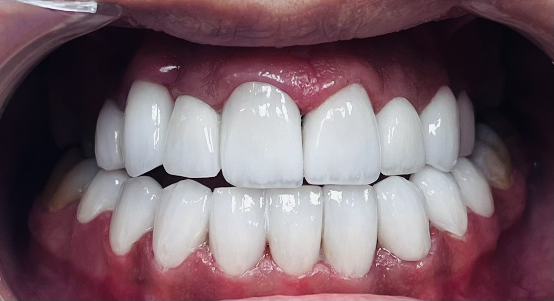 Patient smile result